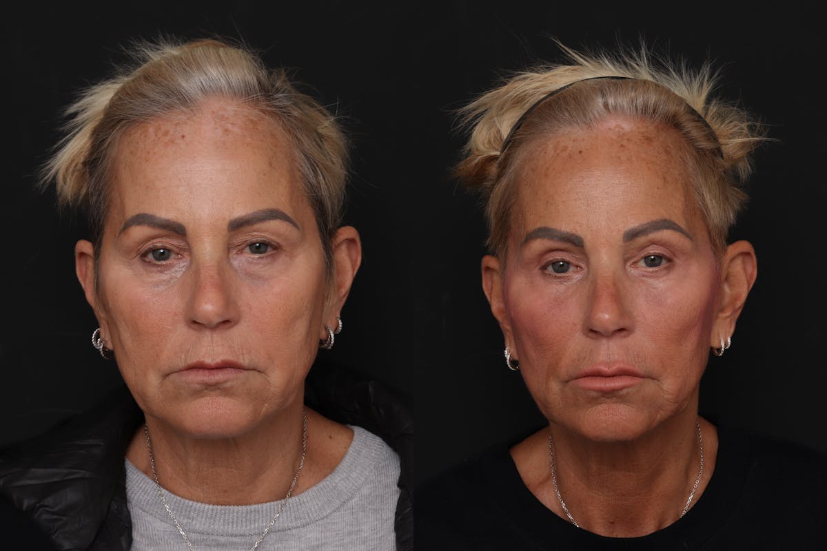 Lower Eyelid Before & After Gallery - Patient 358508 - Image 1