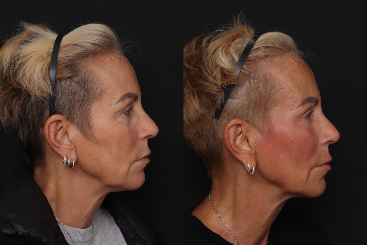 Lower Eyelid Before & After Gallery - Patient 358508 - Image 2