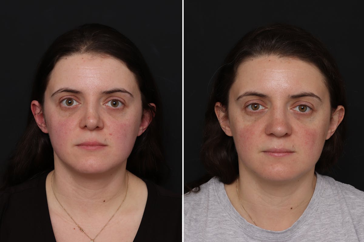 Revision Rhinoplasty Before & After Gallery - Patient 182153 - Image 3