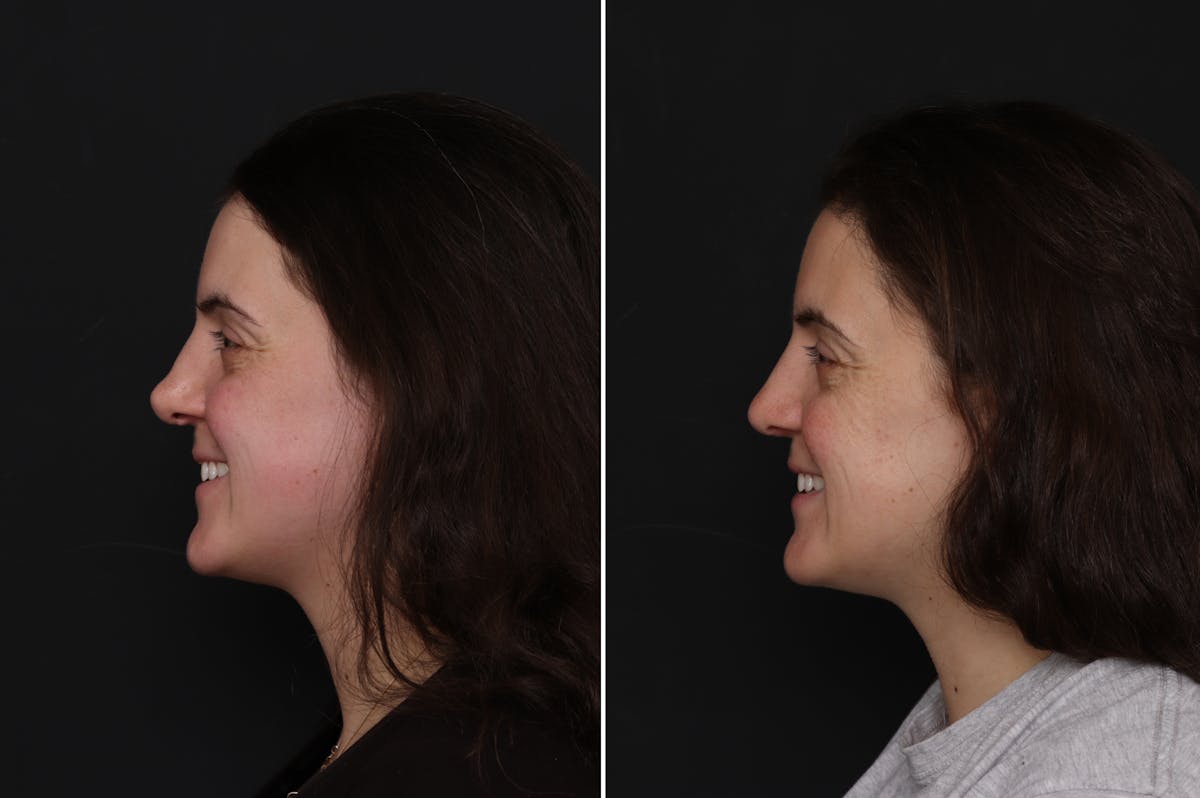 Revision Rhinoplasty Before & After Gallery - Patient 182153 - Image 1
