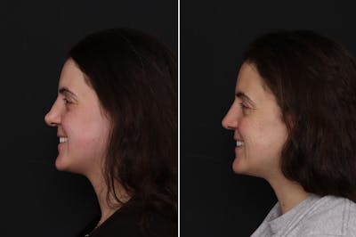Revision Rhinoplasty Before & After Gallery - Patient 182153 - Image 1