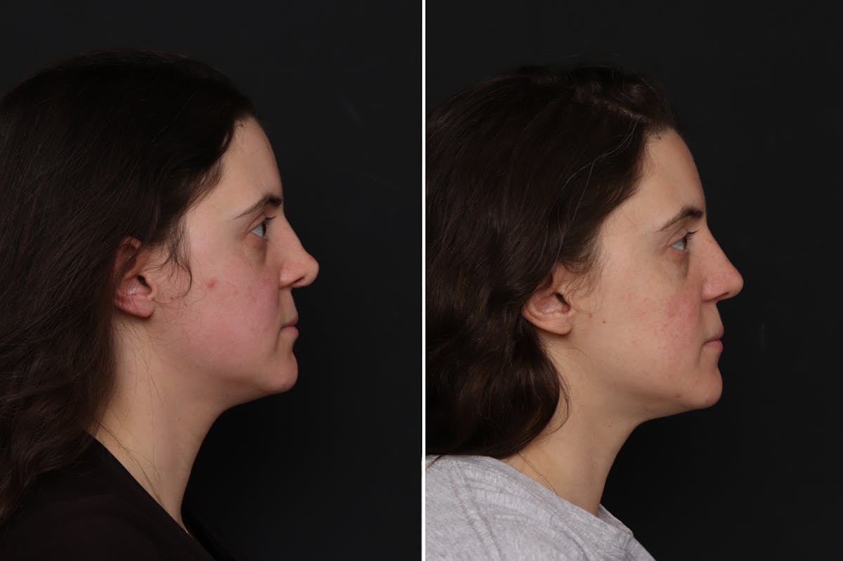 Revision Rhinoplasty Before & After Gallery - Patient 182153 - Image 2
