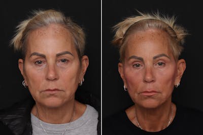 Upper Eyelid Before & After Gallery - Patient 264558 - Image 1