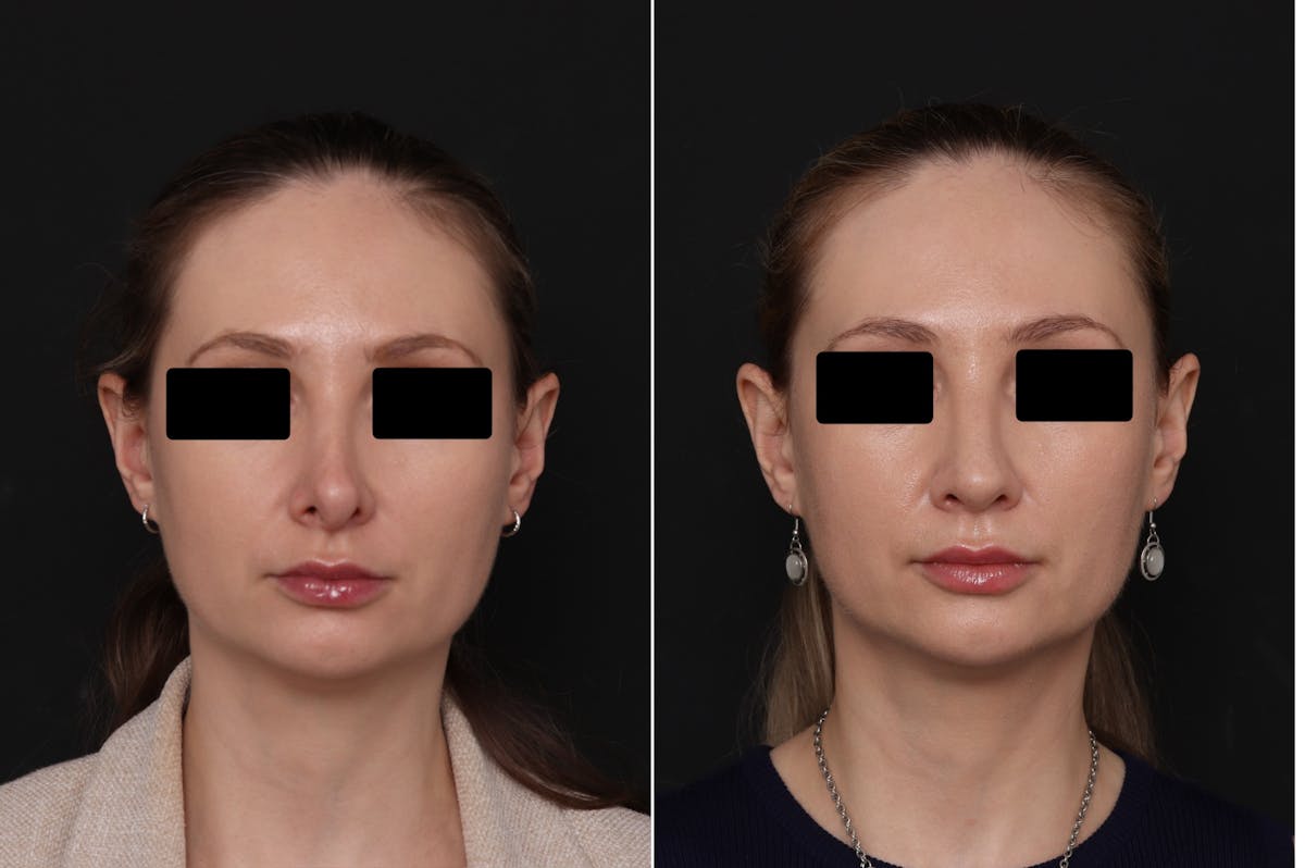 Revision Rhinoplasty Before & After Gallery - Patient 403507 - Image 4