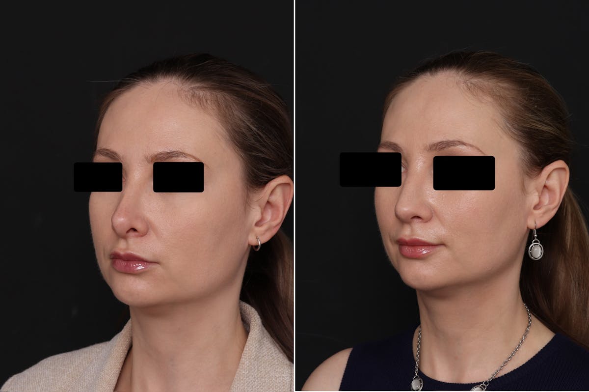 Revision Rhinoplasty Before & After Gallery - Patient 403507 - Image 3