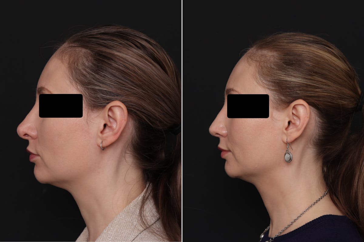 Revision Rhinoplasty Before & After Gallery - Patient 403507 - Image 1