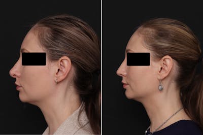 Revision Rhinoplasty Before & After Gallery - Patient 403507 - Image 1