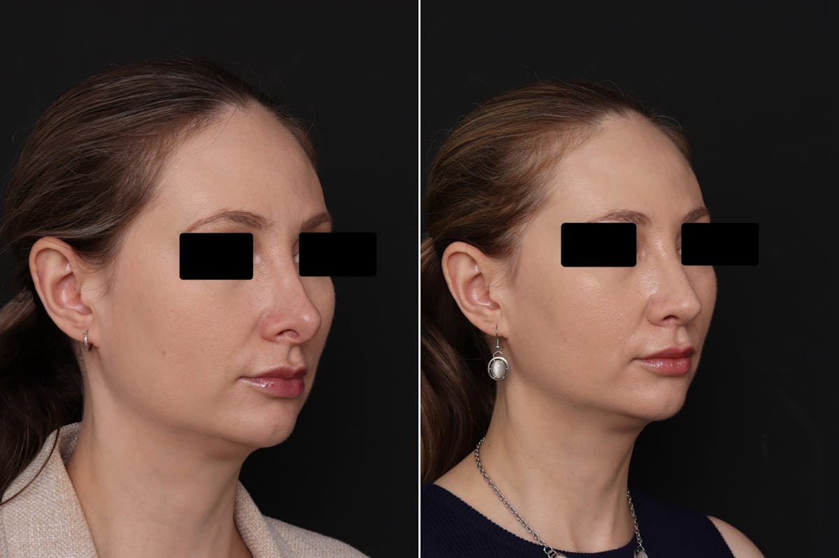 Revision Rhinoplasty Before & After Gallery - Patient 403507 - Image 2