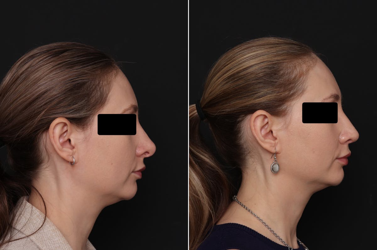 Revision Rhinoplasty Before & After Gallery - Patient 403507 - Image 5