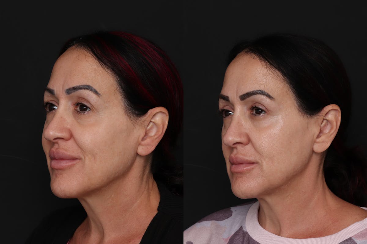 Upper Eyelid Before & After Gallery - Patient 350475 - Image 3