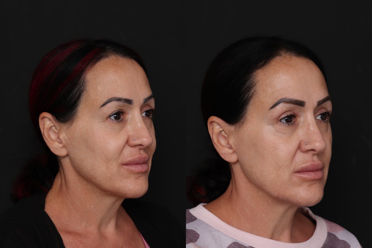 Upper Eyelid Before & After Gallery - Patient 350475 - Image 2