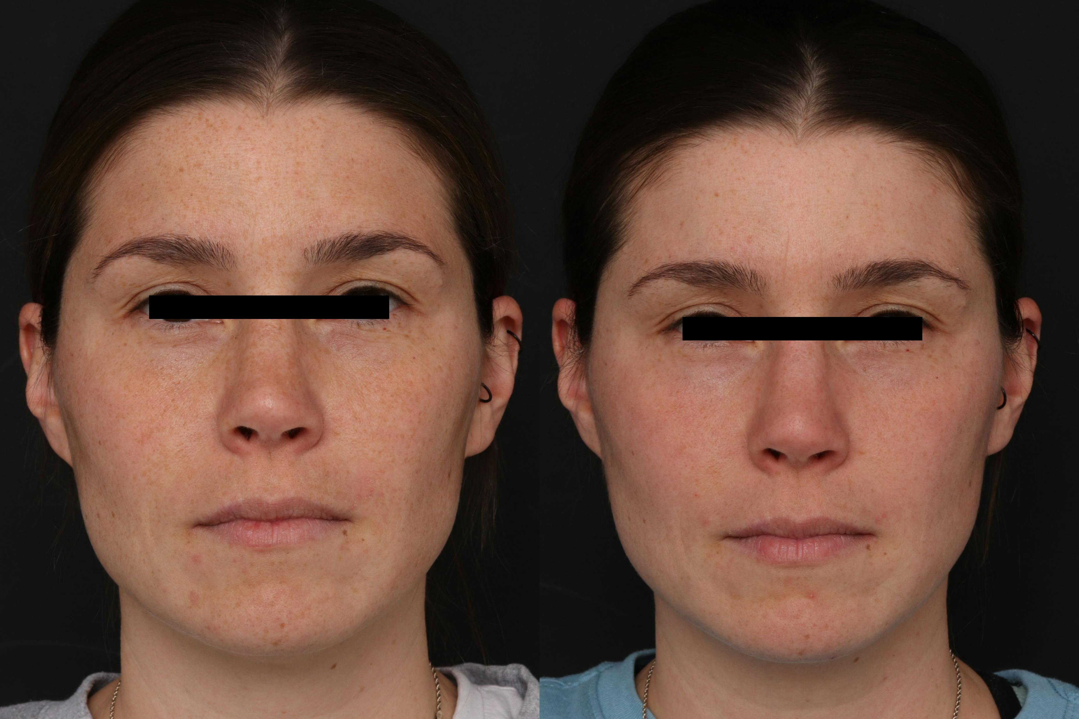 CO2 Laser Resurfacing