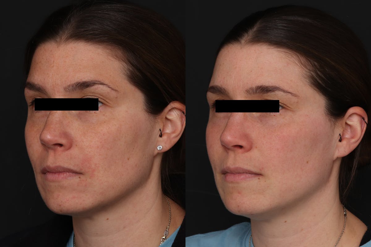 CO2 Laser Resurfacing Before & After Gallery - Patient 281847 - Image 2
