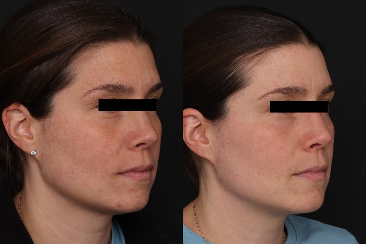 CO2 Laser Resurfacing Before & After Gallery - Patient 281847 - Image 3