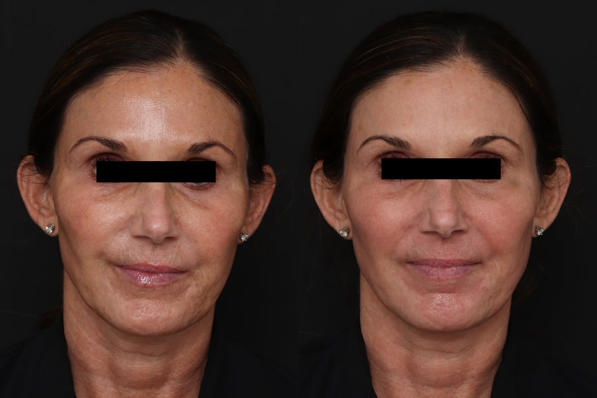 CO2 Laser Resurfacing Before & After Gallery - Patient 356333 - Image 1