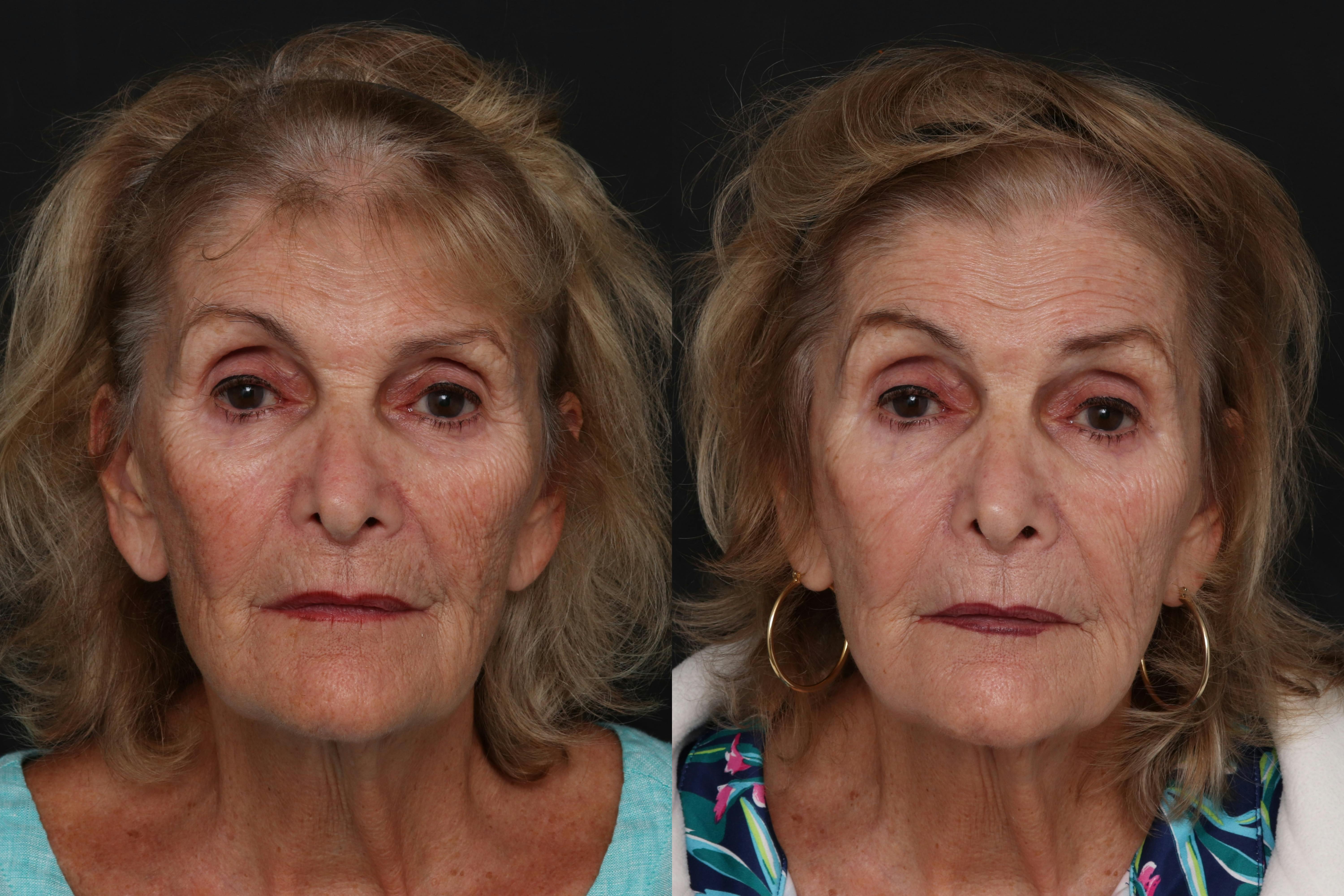 CO2 Laser Resurfacing