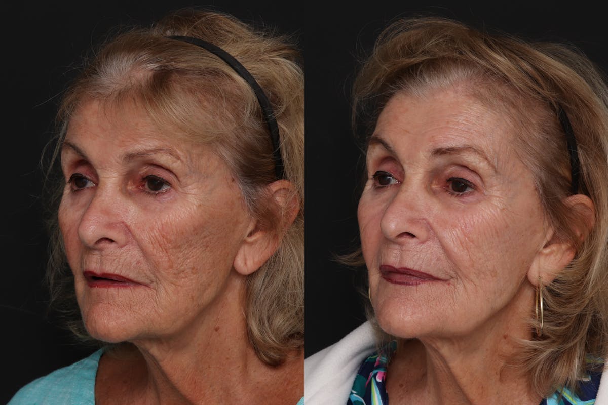 CO2 Laser Resurfacing Before & After Gallery - Patient 892091 - Image 2