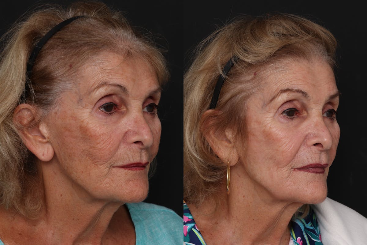 CO2 Laser Resurfacing Before & After Gallery - Patient 892091 - Image 3