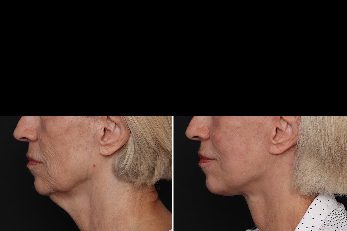 Facelift Before & After Gallery - Patient 228938 - Image 5