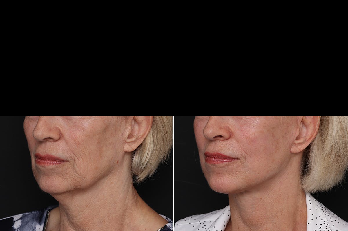 Facelift Before & After Gallery - Patient 228938 - Image 4