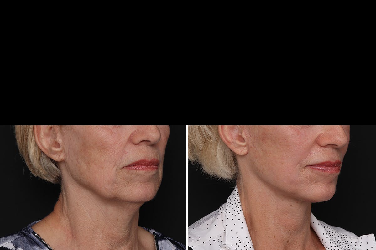 Facelift Before & After Gallery - Patient 228938 - Image 2