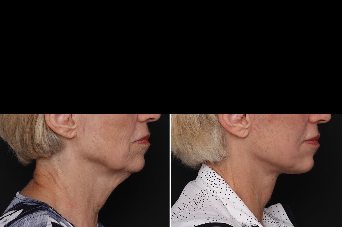 Facelift Before & After Gallery - Patient 228938 - Image 1