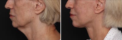 Facelift Before & After Gallery - Patient 228938 - Image 1