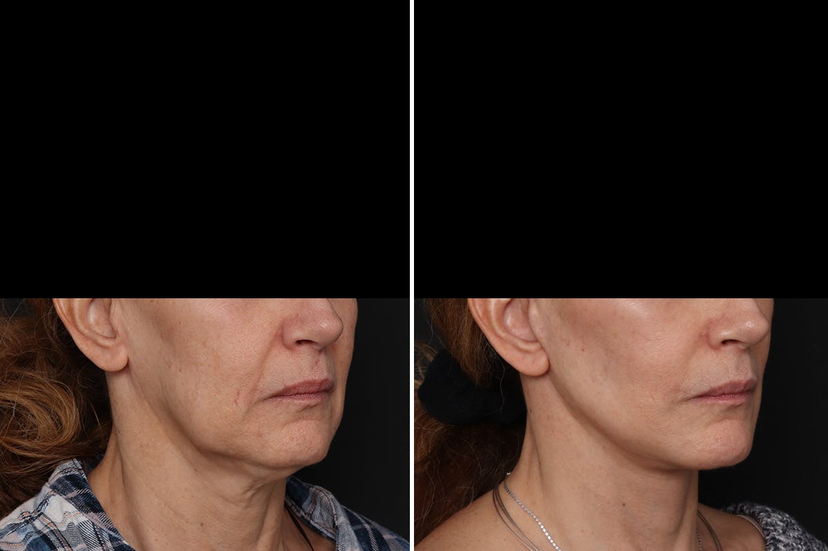 Facelift Before & After Gallery - Patient 217516 - Image 2