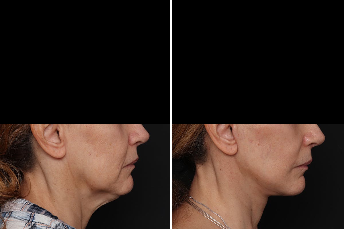 Facelift Before & After Gallery - Patient 217516 - Image 1