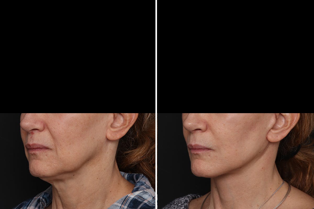 Facelift Before & After Gallery - Patient 217516 - Image 3