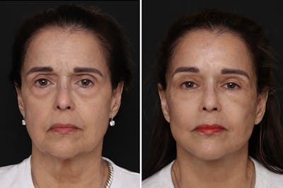 Lower Eyelid Before & After Gallery - Patient 199758 - Image 1