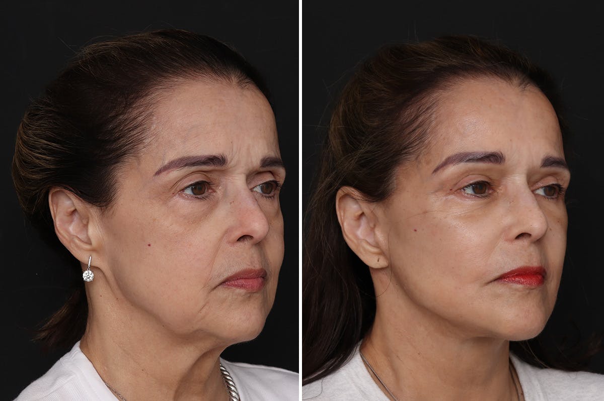 Lower Eyelid Before & After Gallery - Patient 199758 - Image 2