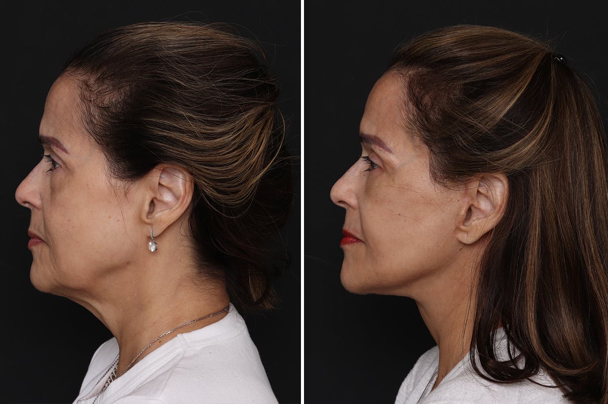 Lower Eyelid Before & After Gallery - Patient 199758 - Image 3