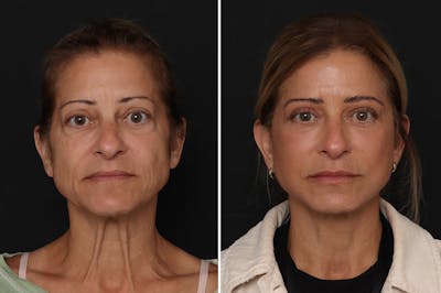 Upper Eyelid Before & After Gallery - Patient 247497 - Image 1