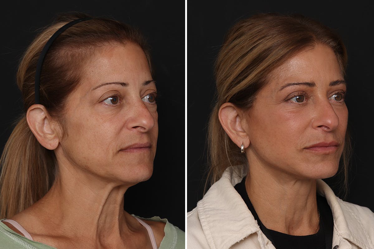Lower Eyelid Before & After Gallery - Patient 141405 - Image 3