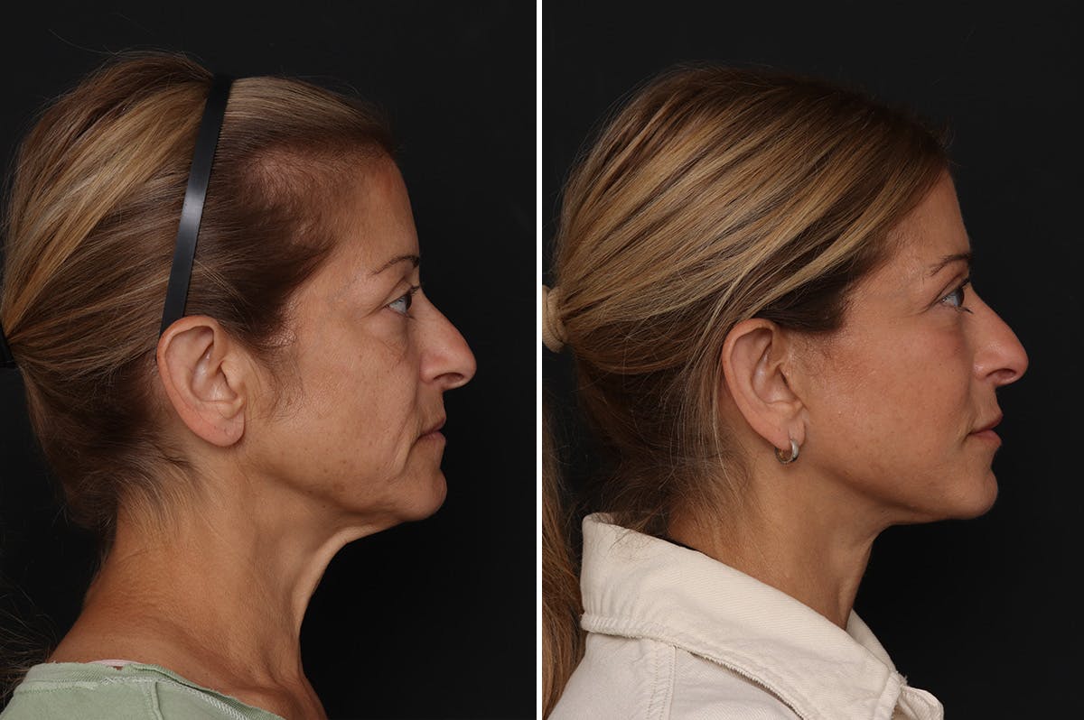 Lower Eyelid Before & After Gallery - Patient 141405 - Image 5