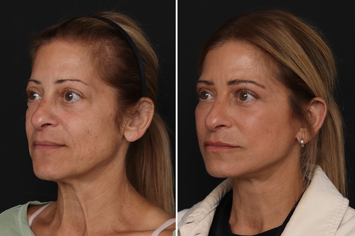 Lower Eyelid Before & After Gallery - Patient 141405 - Image 1