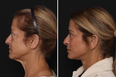 Facelift Before & After Gallery - Patient 401585 - Image 1