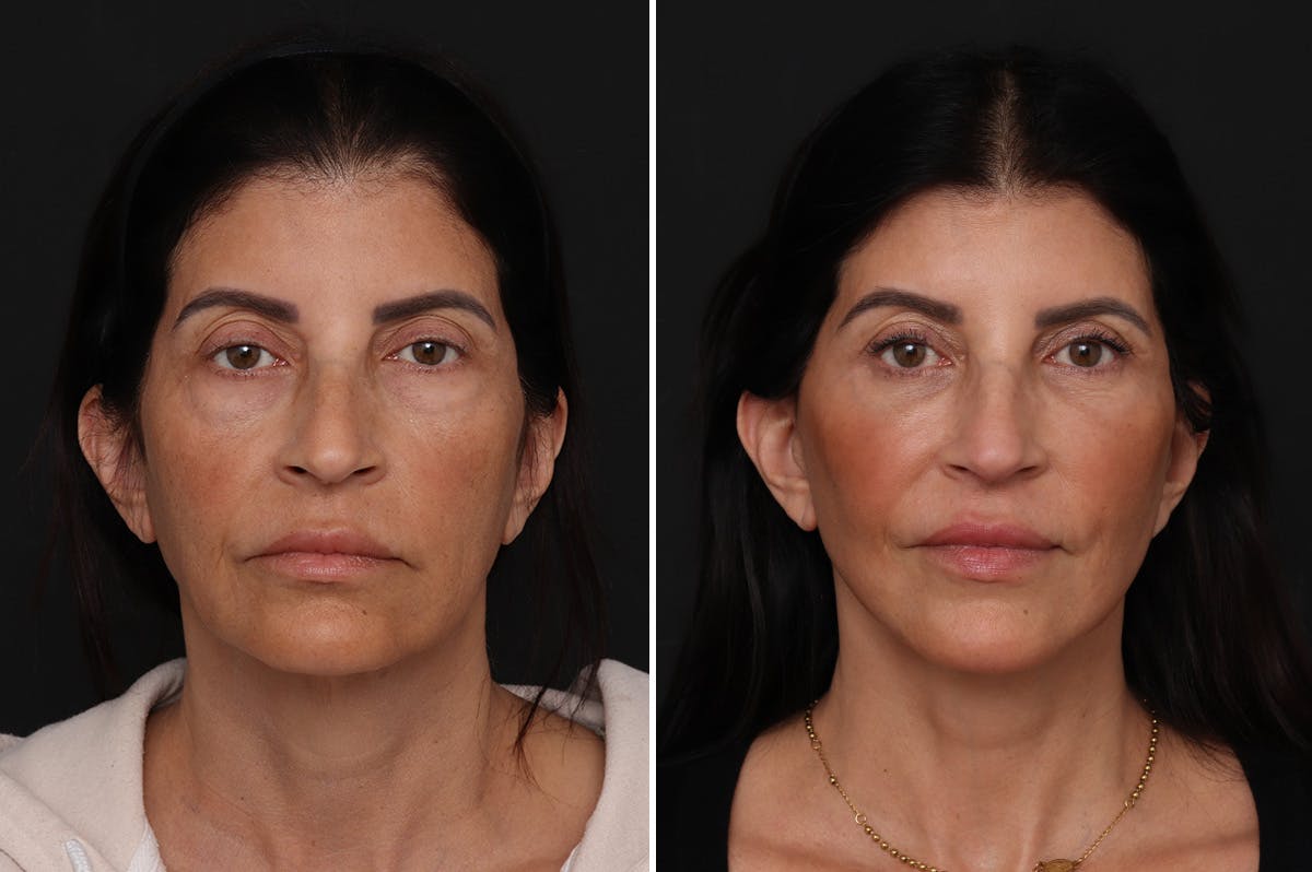 Facelift Before & After Gallery - Patient 342068 - Image 3
