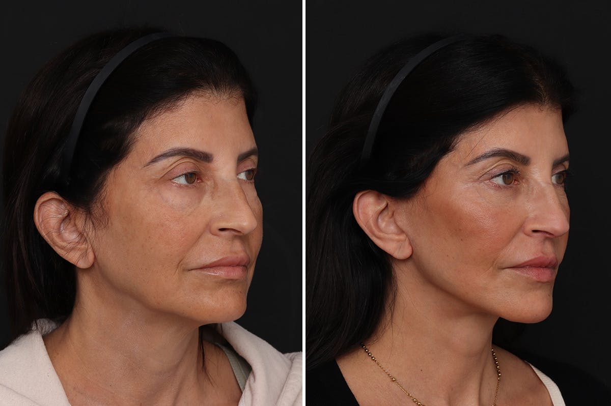 Facelift Before & After Gallery - Patient 342068 - Image 2
