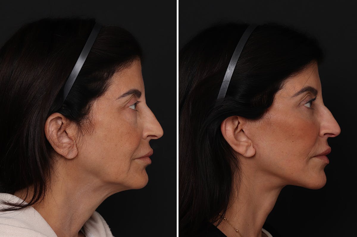 Facelift Before & After Gallery - Patient 342068 - Image 1