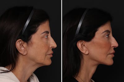 Facelift Before & After Gallery - Patient 342068 - Image 1