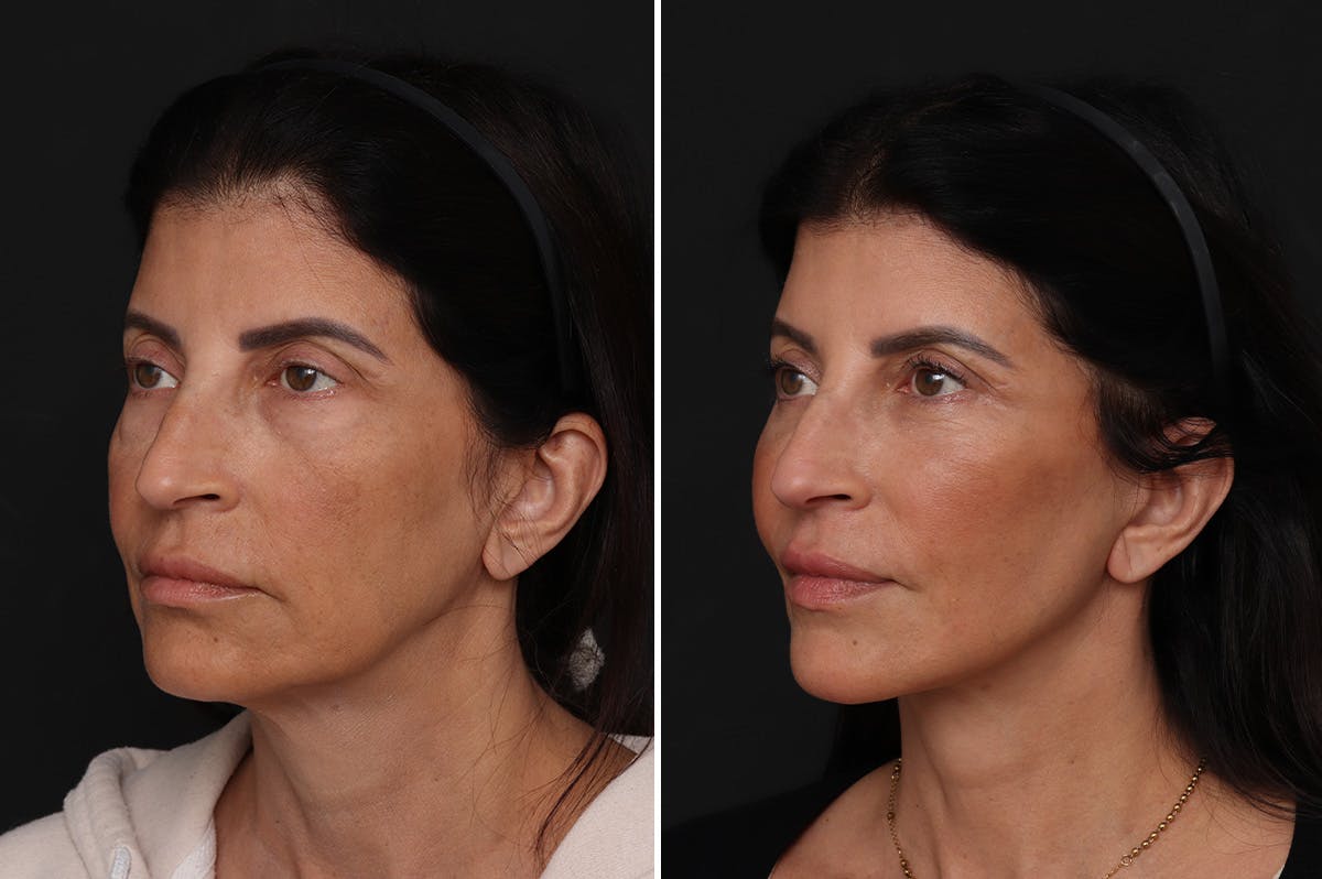 Facelift Before & After Gallery - Patient 342068 - Image 4