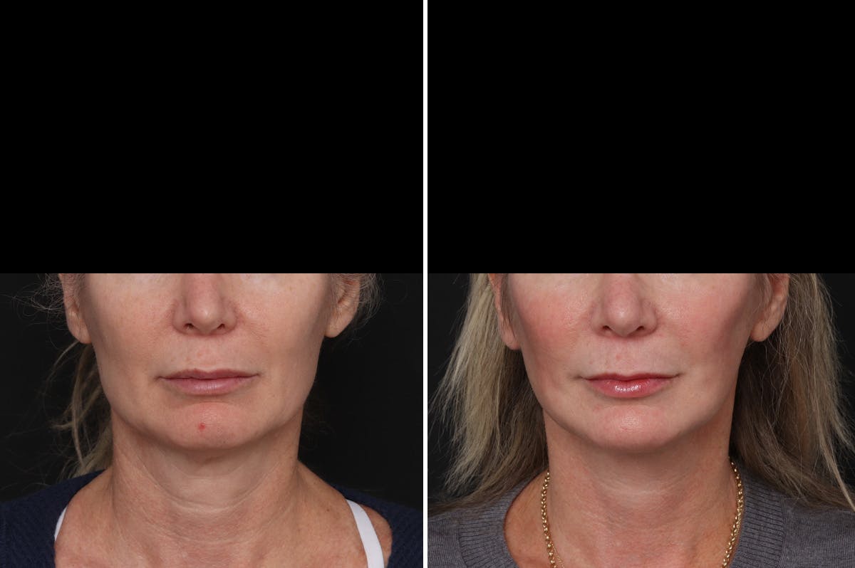 Facelift Before & After Gallery - Patient 271838 - Image 3