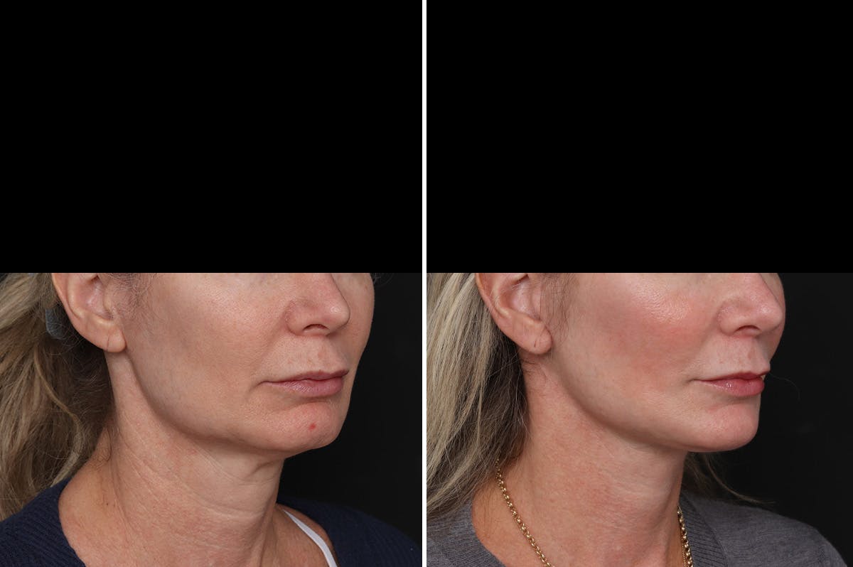 Facelift Before & After Gallery - Patient 271838 - Image 2