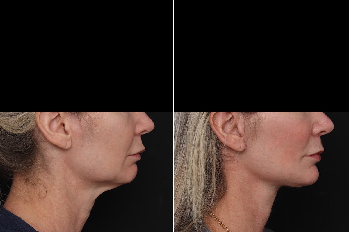 Facelift Before & After Gallery - Patient 271838 - Image 1