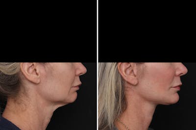 Facelift Before & After Gallery - Patient 271838 - Image 1