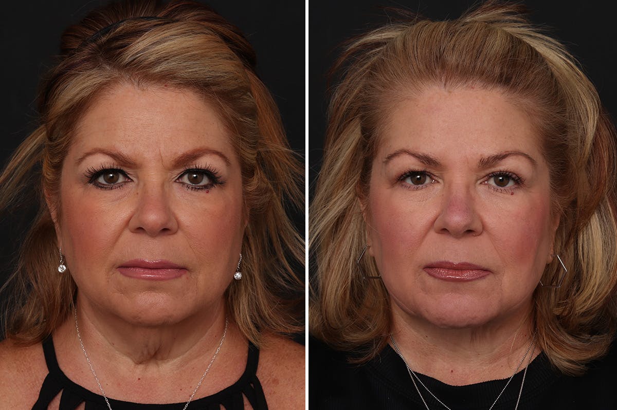Neck Lift Before & After Gallery - Patient 102972 - Image 3