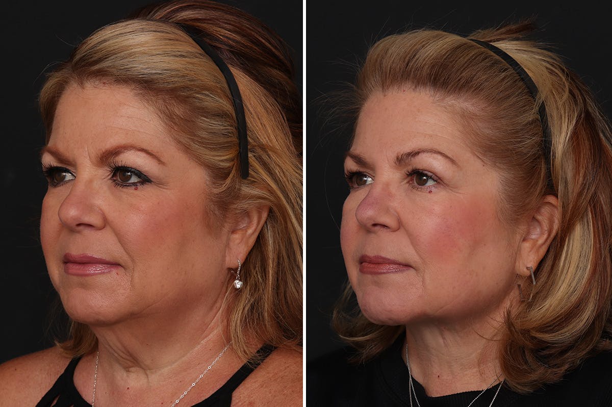 Neck Lift Before & After Gallery - Patient 102972 - Image 2