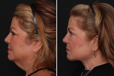 Neck Lift Before & After Gallery - Patient 102972 - Image 1